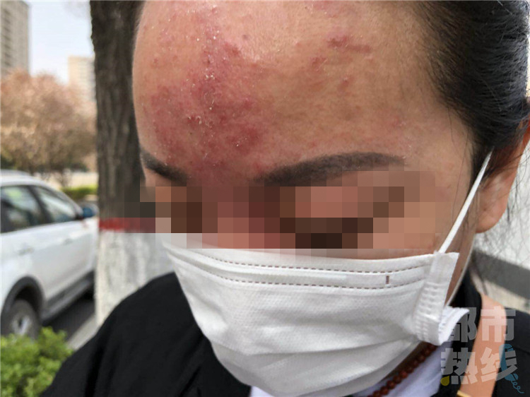 30岁高颜值女子输头孢过敏毁容女子因头孢过敏导致毁容，警示与应对之道